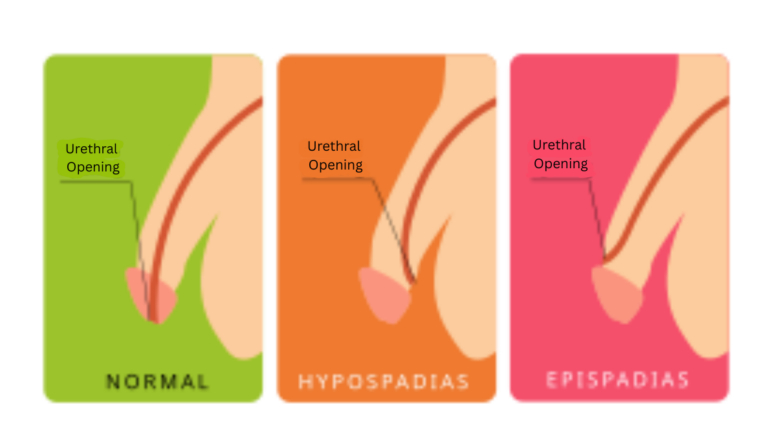 Hypospadias — Circumcision: When “Mild” Still Matters