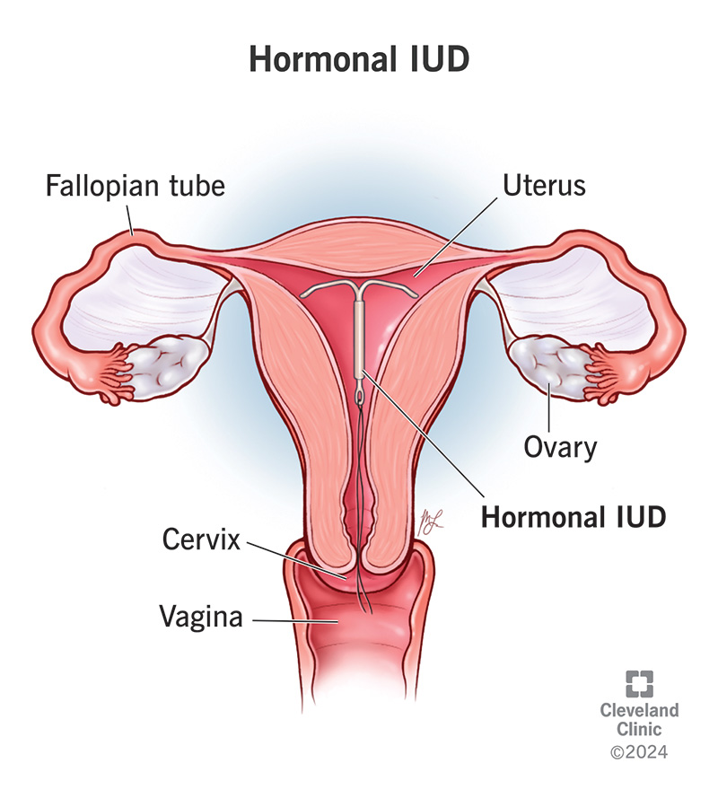 Benefits of Hormonal IUD