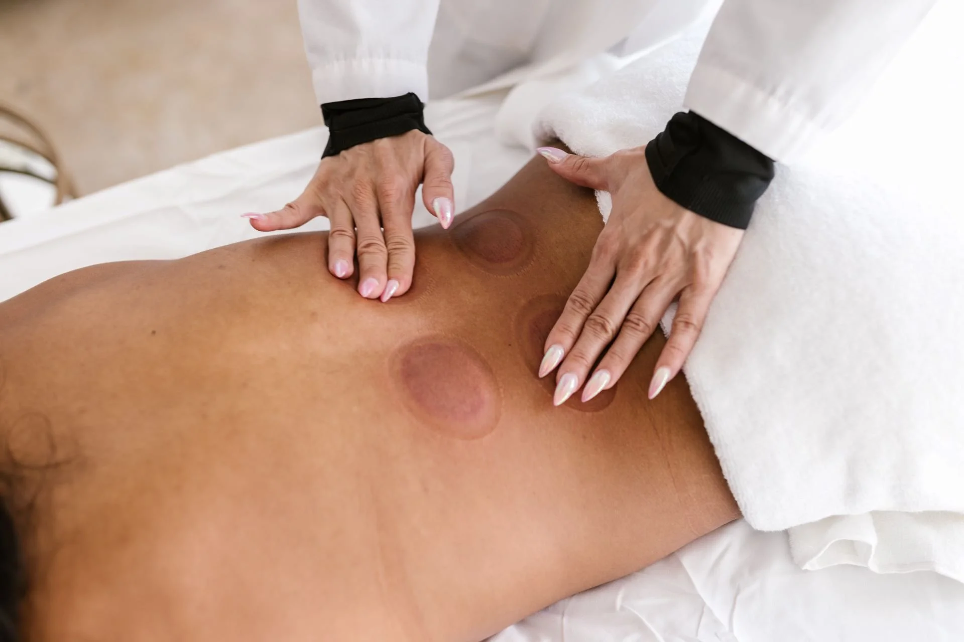 Cupping Therapy in Massage: Ancient Practice, Modern Benefits Cupping Therapy in Massage: Ancient Practice, Modern Benefits - APersonMassagingaVentosaCupMarksonaPatient27sBack